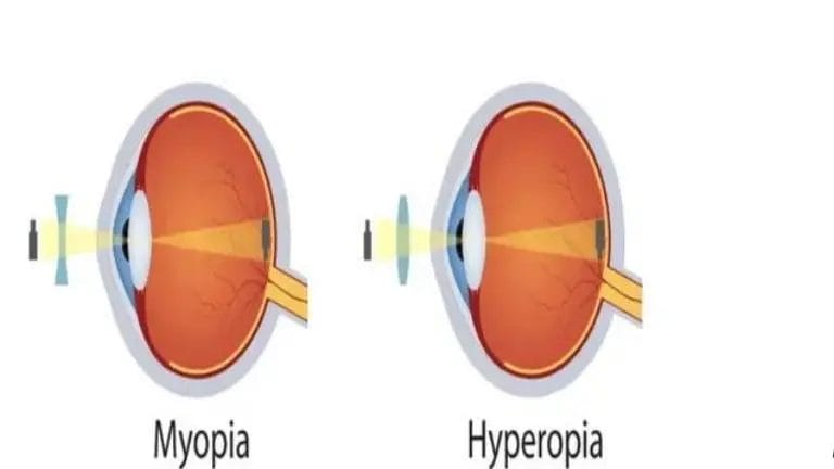 Difference Between Myopia And Hypermetropia