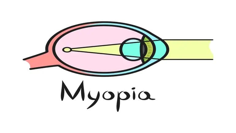 Myopia Signs